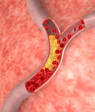 high cholesterol